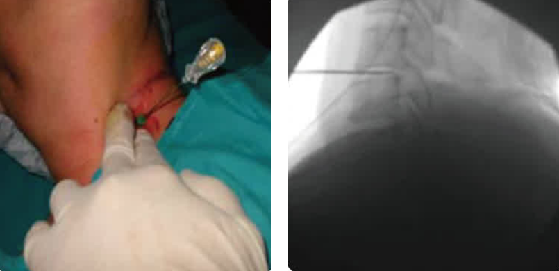 C-arm 유도하 신경성형술