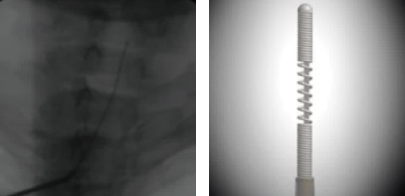 C-arm 유도하 디스크성형술