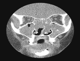 부비동염(축농증)