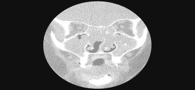 부비동염(축농증)
