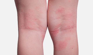 오금 부위의 습진