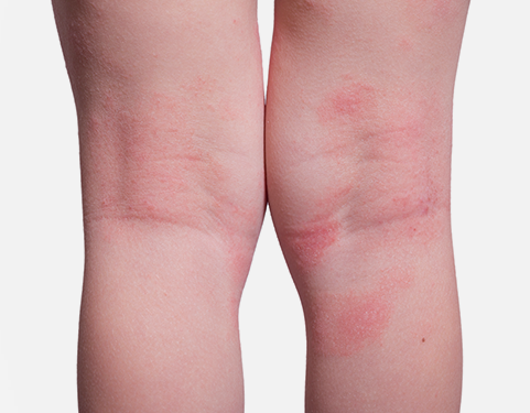 오금 부위의 습진