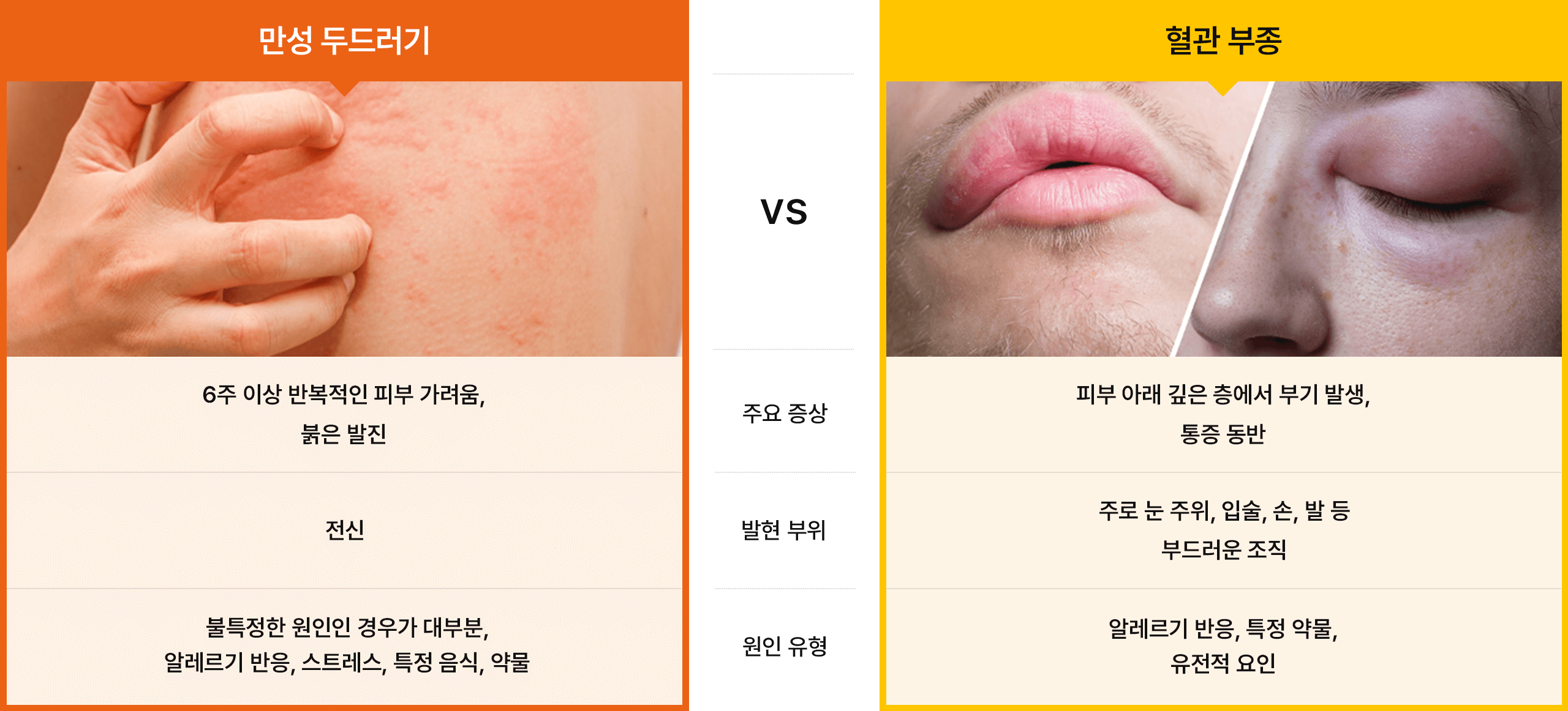 만성 두드러기 · 혈관 부종