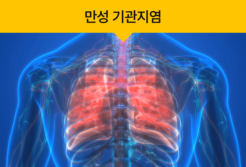 만성 기관지염