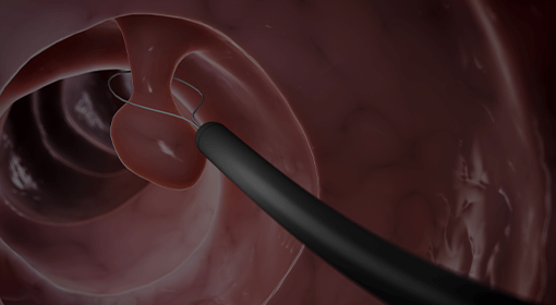 대장용종 발견 및 제거술