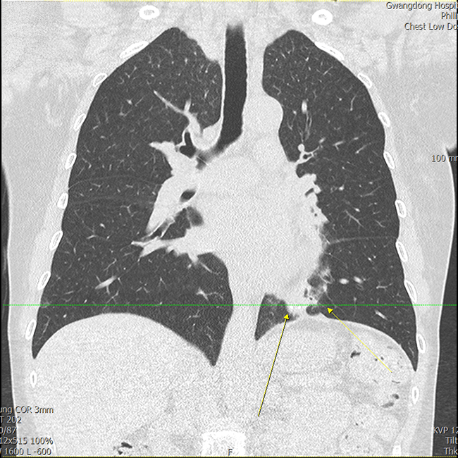흉부 및 폐질환
