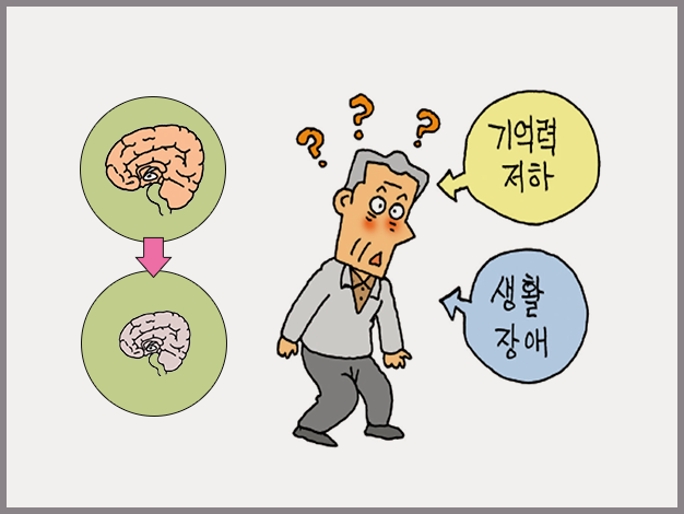 기억력 감퇴