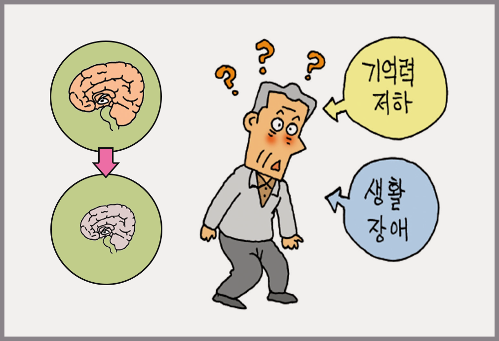기억력 감퇴