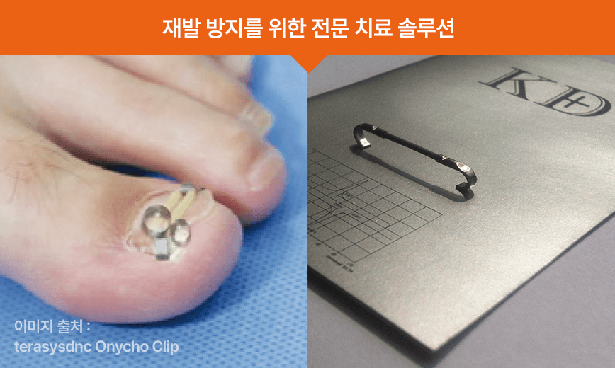 발톱 교정기구장착