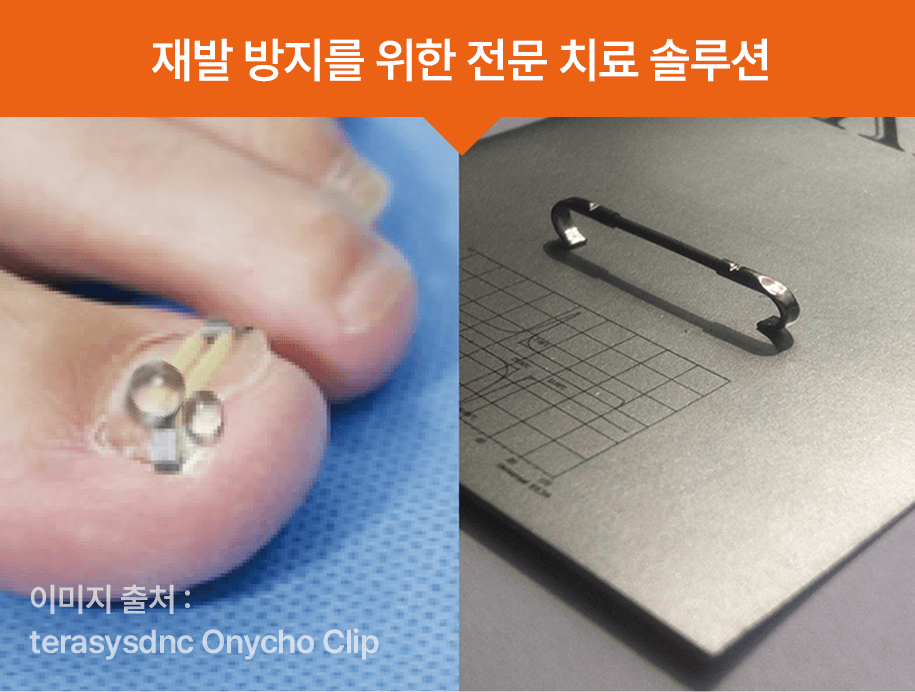 발톱 교정기구장착