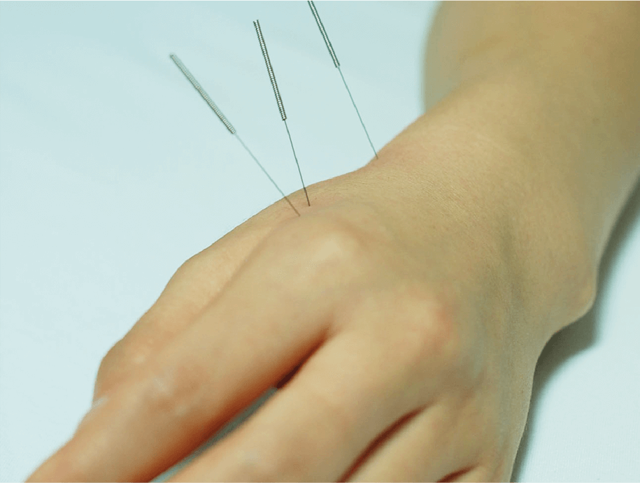 침 치료