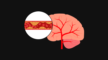 허혈성 뇌졸중(뇌경색)