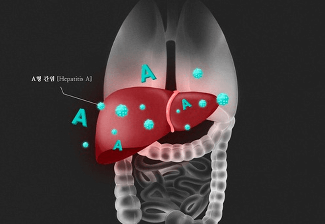A형간염